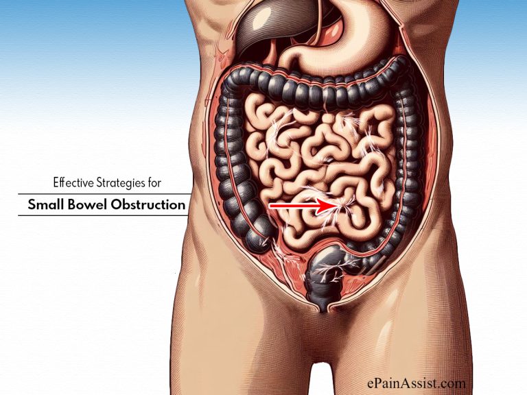 Effective Strategies for Small Bowel Obstruction : A Team-Based Treatment Plan