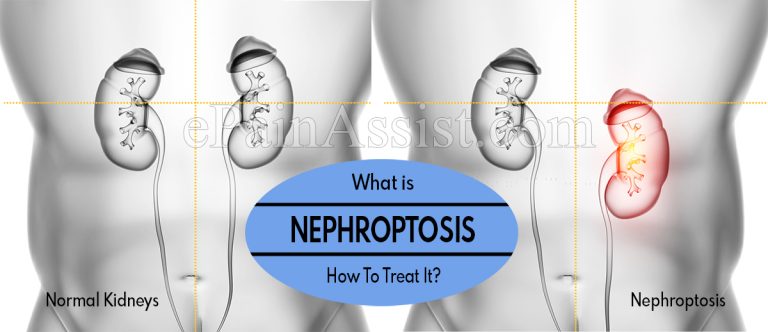 What Causes Nephroptosis and How To Treat It?
