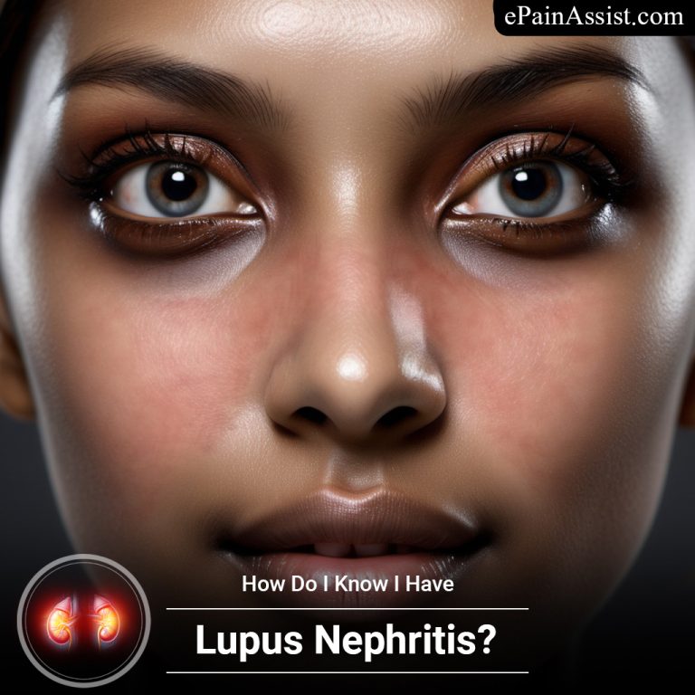 How Do I Know I Have Lupus Nephritis?