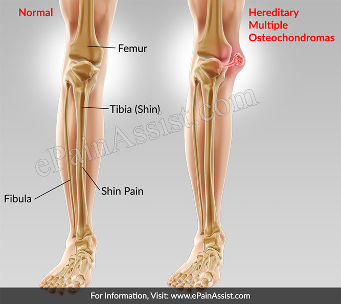 What Is Hereditary Multiple Osteochondromas?