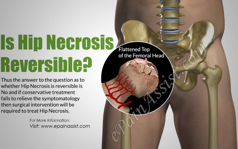 Is Hip Necrosis Reversible?