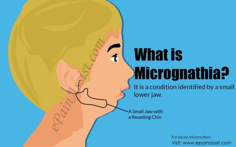 Micrognathia: Causes, Symptoms, Treatment, Prevention, Diagnosis