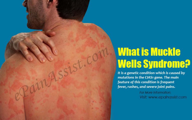 Muckle Wells Syndrome: Causes, Symptoms, Treatment