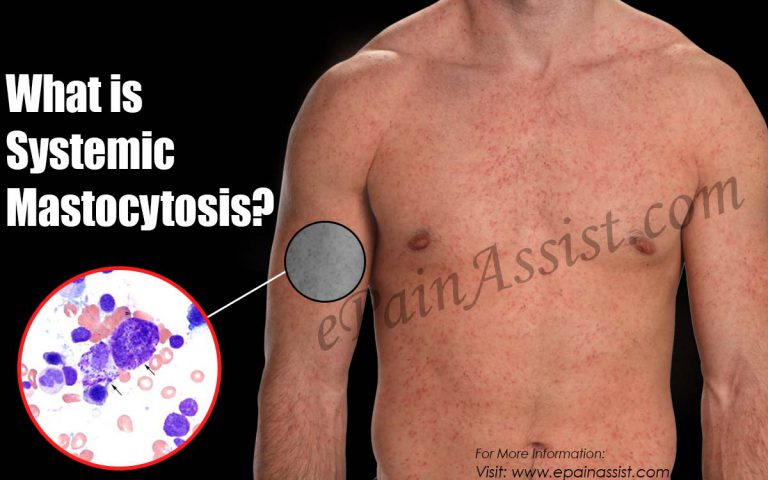 Systemic Mastocytosis: Causes, Symptoms, Treatment, Diagnosis