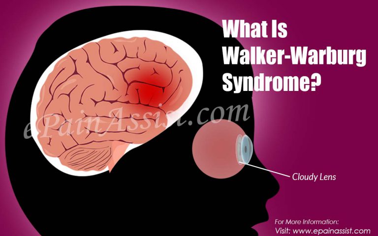 What is Walker-Warburg Syndrome & How is it Treated?
