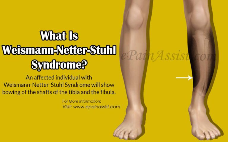 What is Weismann-Netter-Stuhl Syndrome: Causes, Symptoms, Treatment, Diagnosis