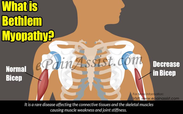 What is Bethlem Myopathy, Know it’s Causes, Symptoms, Treatment, Diagnosis
