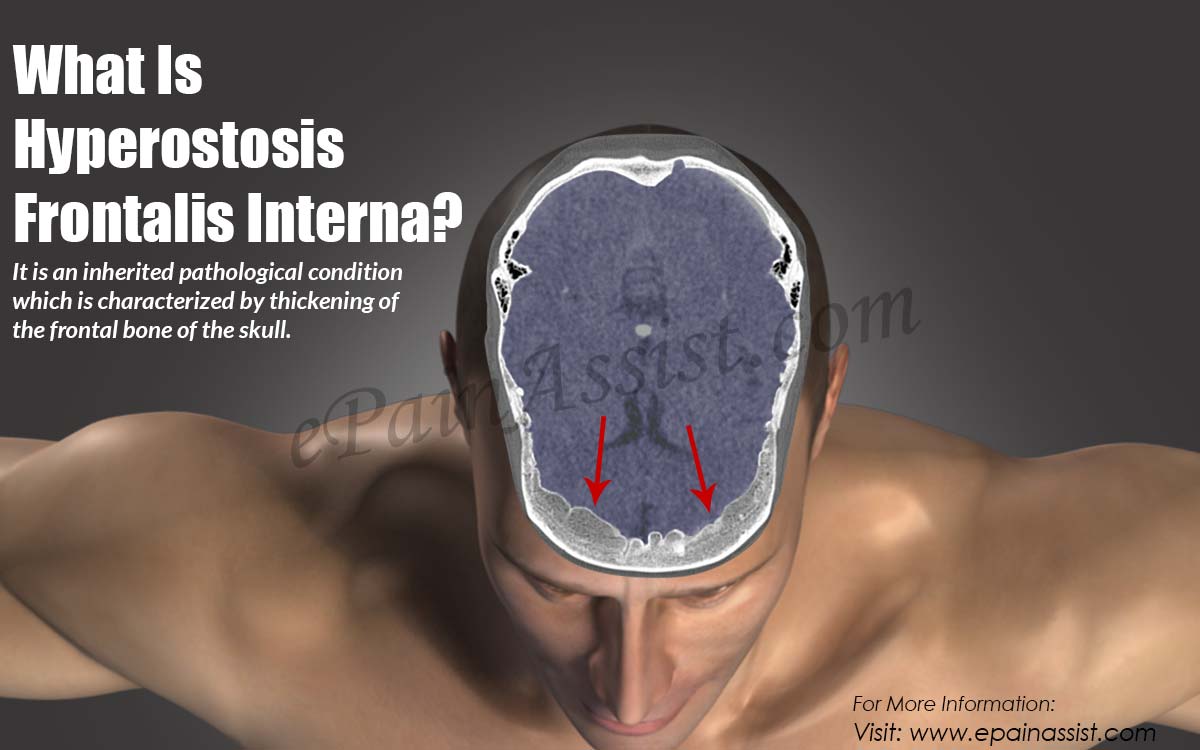 What Is Hyperostosis Frontalis Interna?