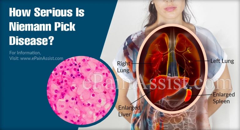 Is Niemann Pick Disease A Serious Condition & Can It Be Reversed?