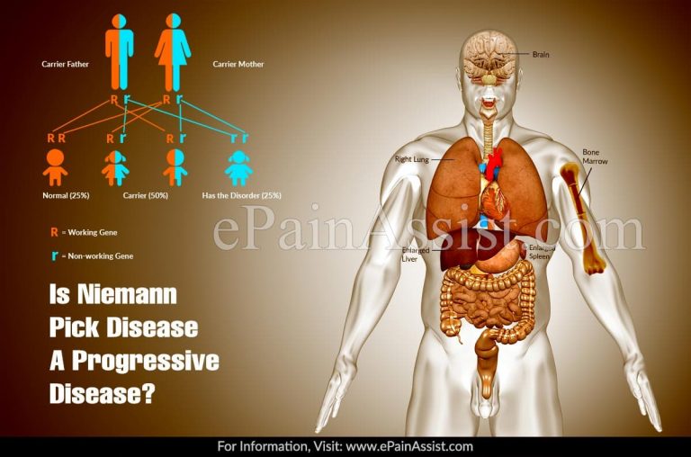 Is Niemann Pick Disease A Progressive Disease & Alternative Treatments For It