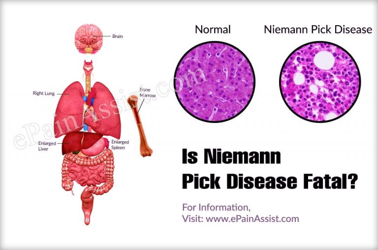 Is Niemann Pick Disease Fatal & Is It Dominant Or Recessive?