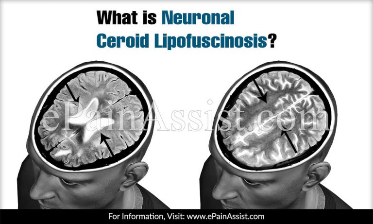 Neuronal Ceroid Lipofuscinosis – Causes, Symptoms, Diagnosis & Treatment