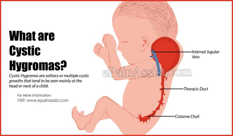 Cystic Hygroma: Causes, Symptoms, Treatment, Diagnosis