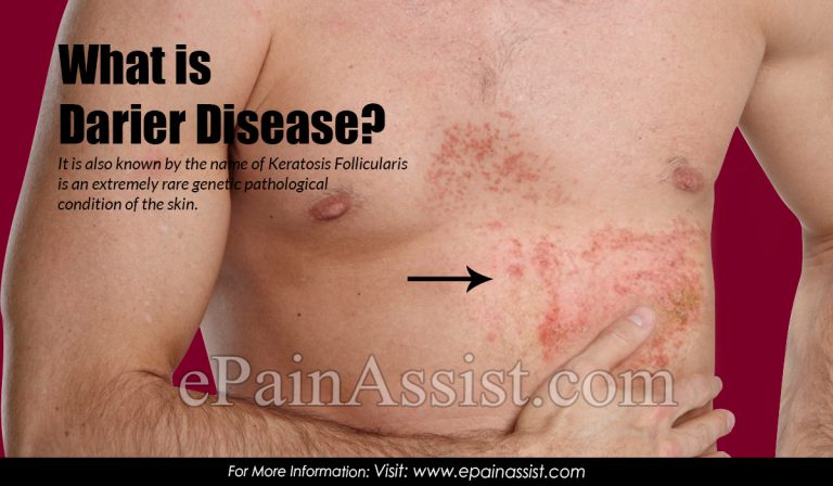 What is Darier Disease & How is it Treated?