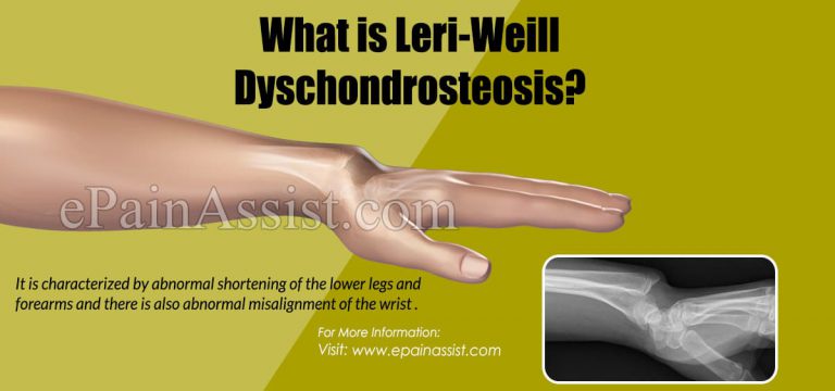 What is Leri-Weill Dyschondrosteosis: Causes, Symptoms, Treatment, Diagnosis