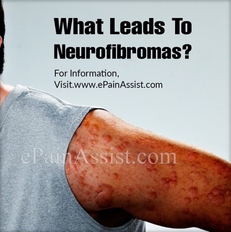 What Leads To Neurofibromas & Can They Be Cured?