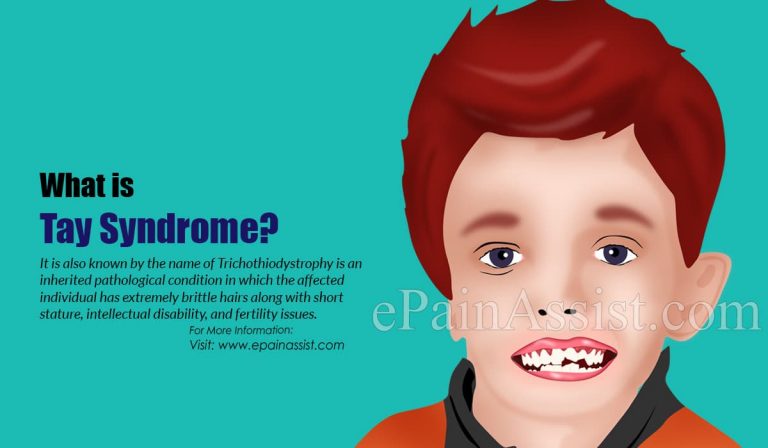 Tay Syndrome: Causes, Symptoms, Treatment