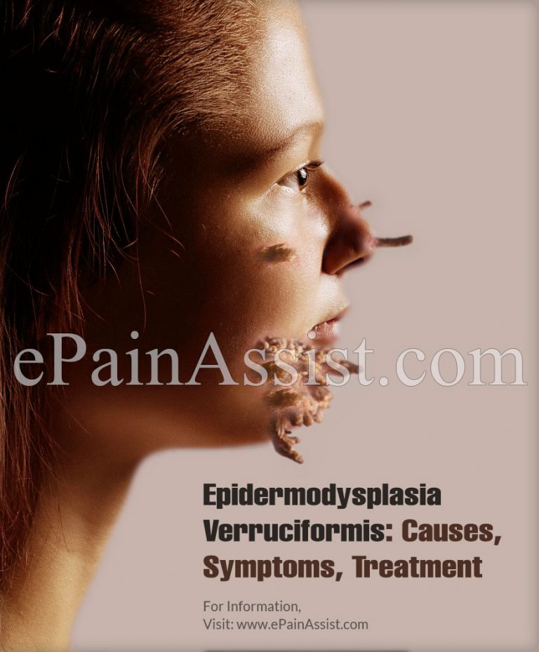 Epidermodysplasia Verruciformis: Causes, Symptoms, Treatment