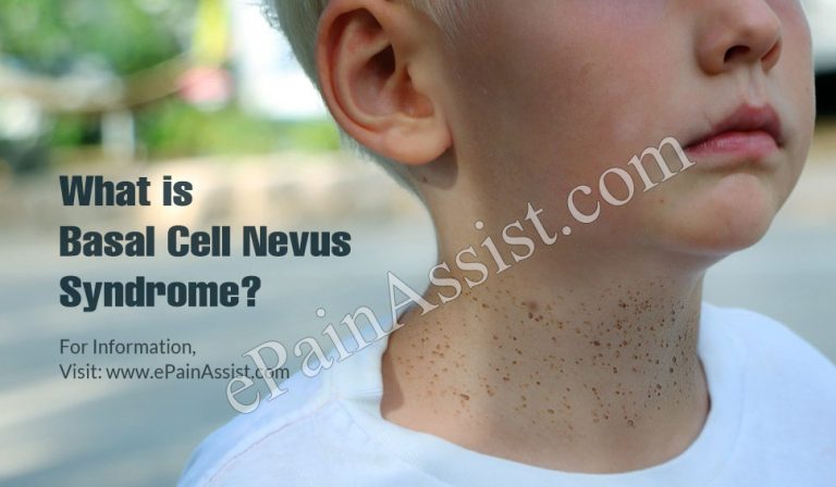 What is Basal Cell Nevus Syndrome & How is it Treated? | Causes, Symptoms and Outlook of Basal Cell Nevus Syndrome