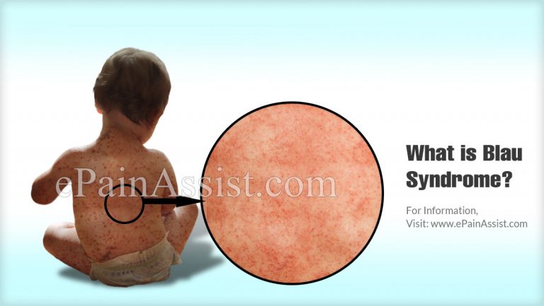 What is Blau Syndrome: Causes, Symptoms, Treatment, Prognosis