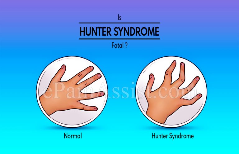 Is Hunter Syndrome Fatal & What Are Its Complications?
