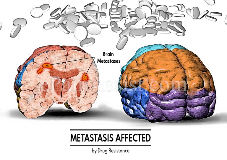 Metastasis Affected by Drug Resistance