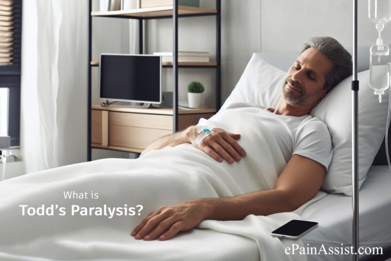 Todd’s Paralysis: Causes, Symptoms, Treatment, How is Todd’s Paralysis Different From Stroke?
