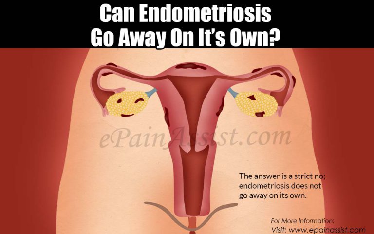 Can Endometriosis Go Away On It’s Own?