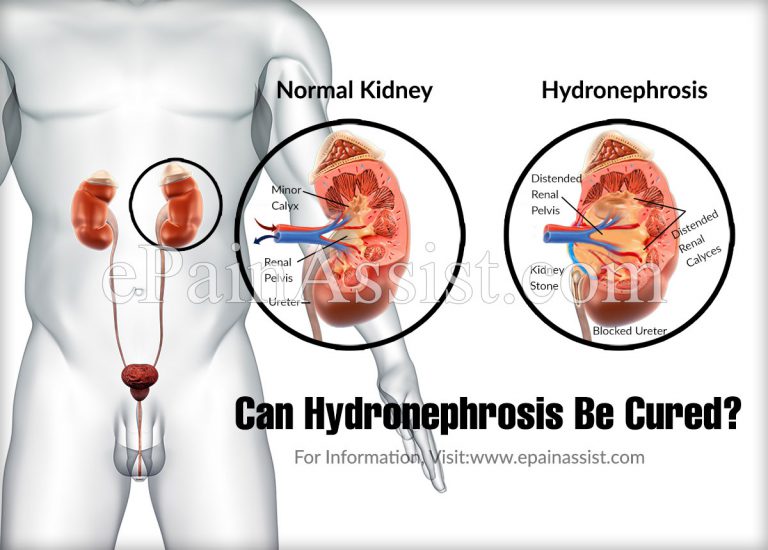 Can Hydronephrosis Be Cured?