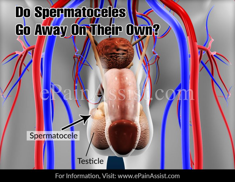 Do Spermatoceles Go Away On Their Own?