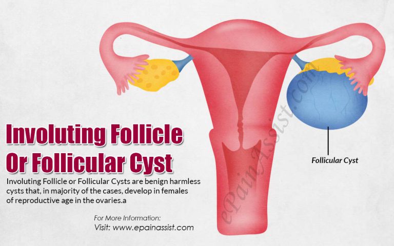 Involuting Follicle Or Follicular Cyst: Causes, Symptoms, Treatment