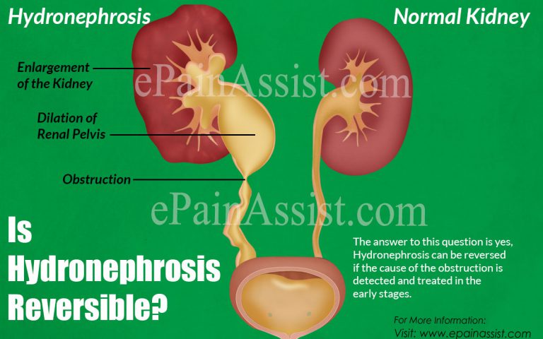 Is Hydronephrosis Reversible?