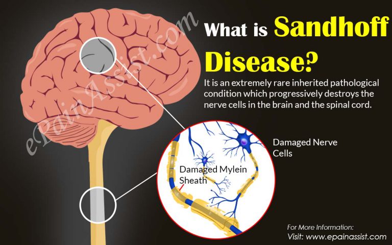 What is Sandhoff Disease & How is it Treated?