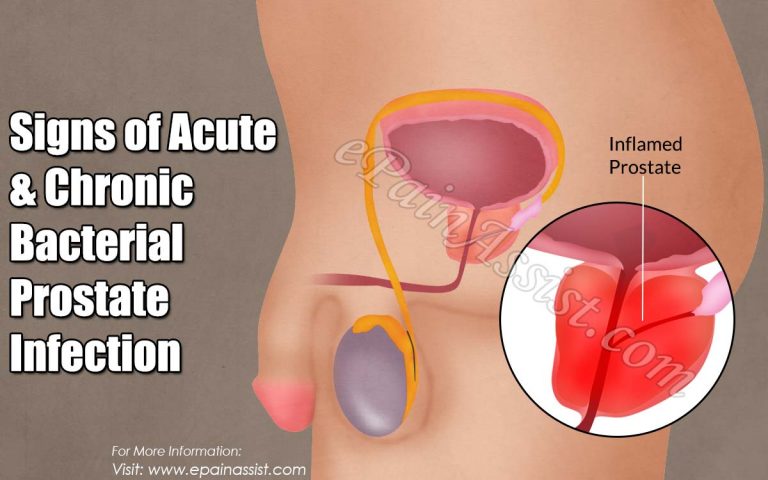 Signs of Acute & Chronic Bacterial Prostate Infection