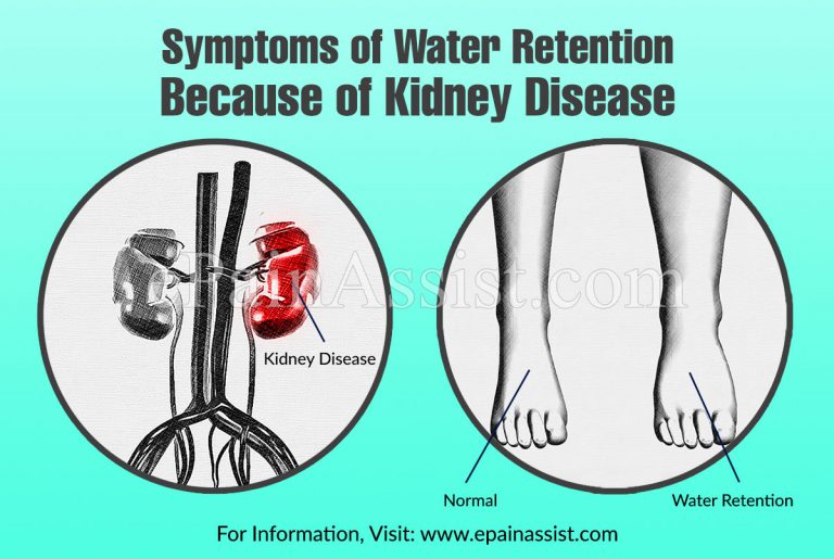 Symptoms & Causes of Water Retention Because of Kidney Disease