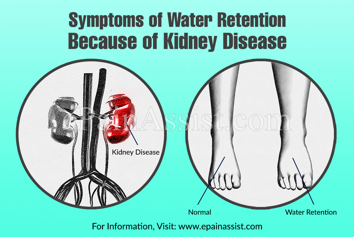 Symptoms of Water Retention Because of Kidney Disease