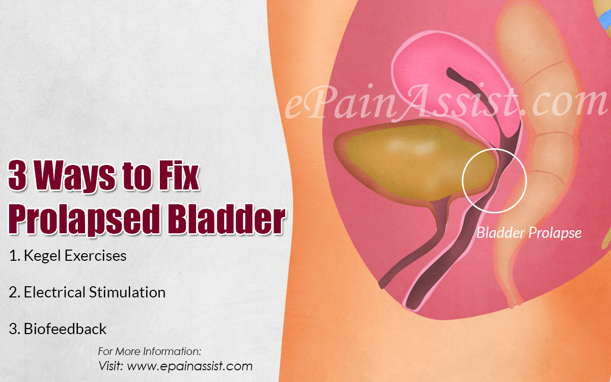 3 Ways to Fix Prolapsed Bladder 3 Ways to Fix Prolapsed Bladder