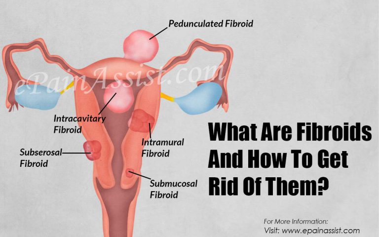 What Are Fibroids And How To Get Rid Of Them?