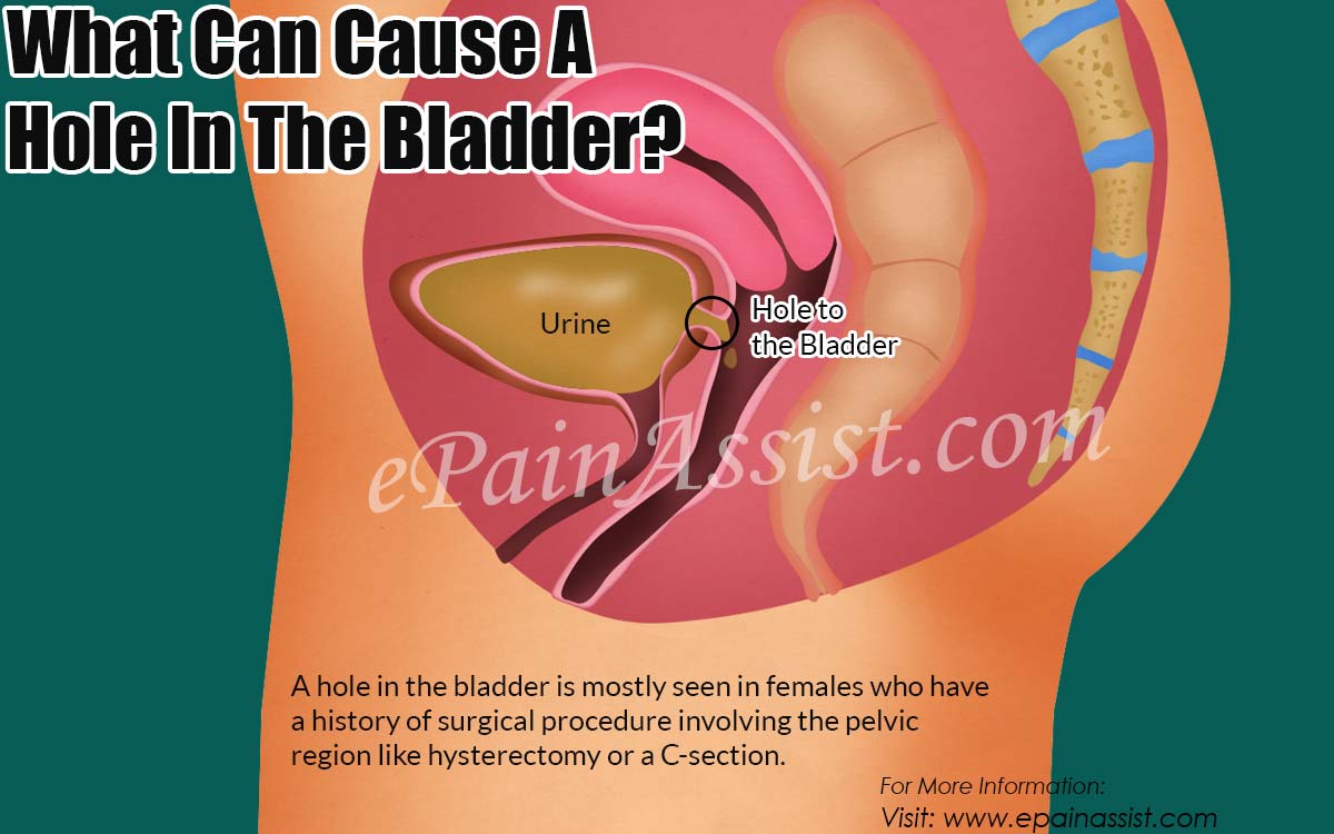 What Can Cause A Hole In The Bladder?