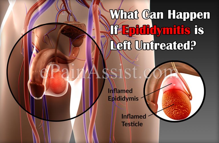 What Can Happen If Epididymitis is Left Untreated?