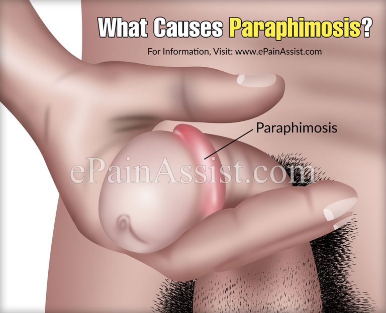 What Causes Paraphimosis?
