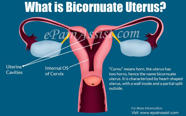 What is Bicornuate Uterus & How is it Treated?|Causes, Symptoms, Surgery, Complications of Bicornuate Uterus