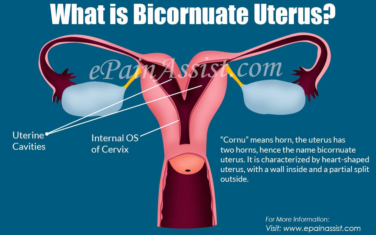 What is Bicornuate Uterus?