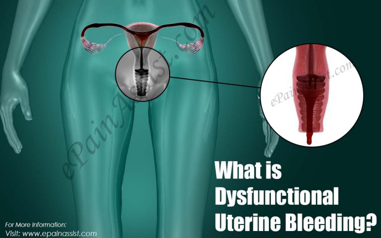 What is Dysfunctional Uterine Bleeding: Types, Causes, Symptoms, Treatment, Diagnosis
