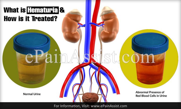 What is Hematuria & How is it Treated?|Types, Causes, Symptoms, Risks of Hematuria