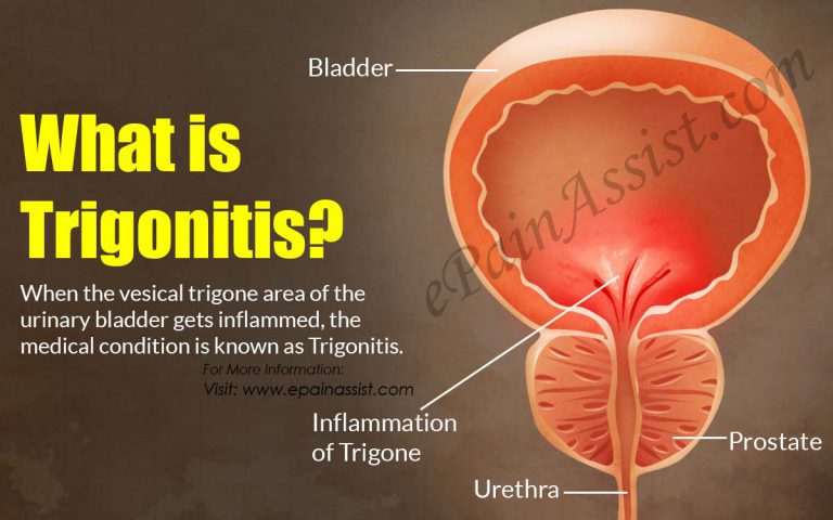 What is Trigonitis: Symptoms, Causes, Treatment, Diagnosis, Prevention