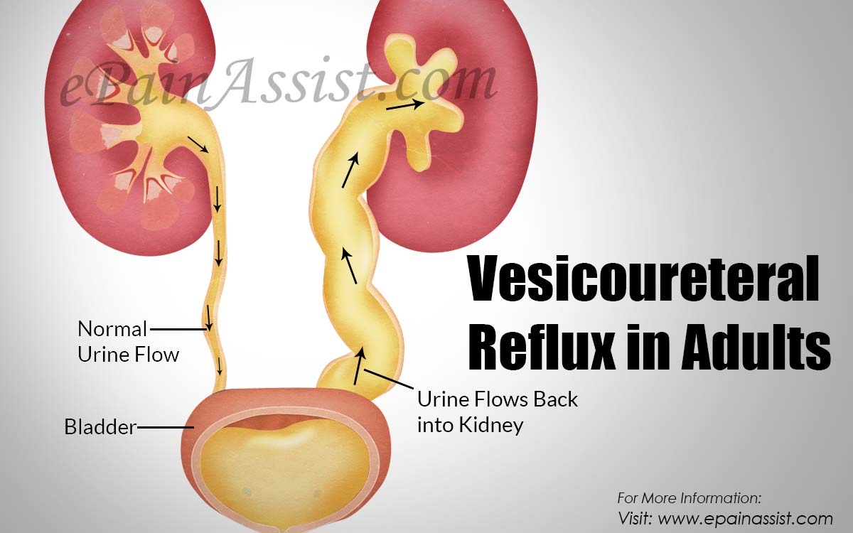 Vesicoureteral Reflux in Adults