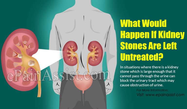 What Would Happen If Kidney Stones Are Left Untreated?