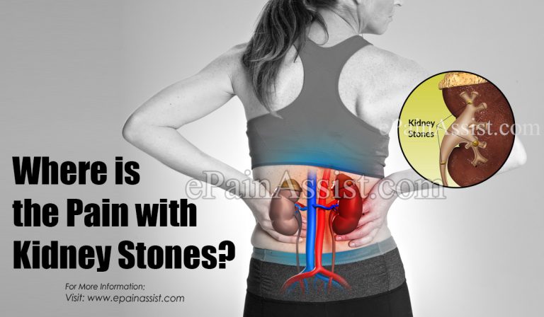Where Is The Pain With Kidney Stones?