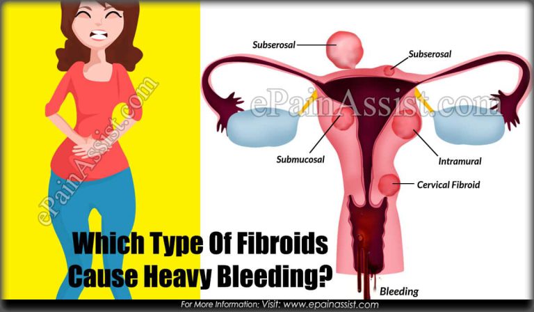 Which Type Of Fibroids Cause Heavy Bleeding?